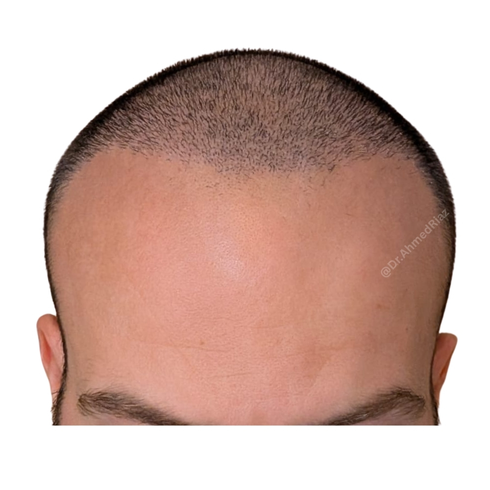 After image